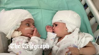 Israeli doctors separate conjoined twins in extremely rare operation