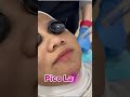 JERAGAT atau PIGMENTATION (By Dr Syahida)