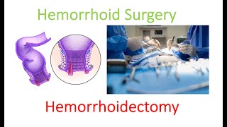 What is hemorrhoidectomy surgery? Get the REAL details here! | Dr. Chung explains