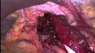 NOVEL COMBINED VATS/LAPAROSCOPIC APPROACH FOR GIANT AND COMPLICATED PARAESOPHAGEAL HERNIA REPAIR