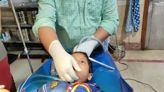 Removing coin from throat of 4 year old boy