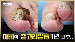 1년 반 만에 다시! 갈고리 노인성 발톱 관리 [풋스올서초이수점]