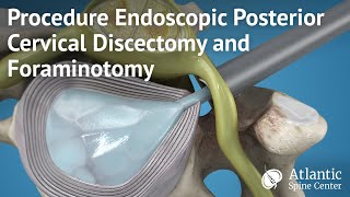 Procedure Endoscopic Posterior Cervical Discectomy and Foraminotomy