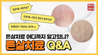 [튼살 없애는 방법]튼살치료 어디까지 알고있니? 튼살치료 무엇이든 물어보세요!