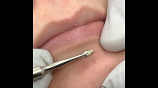 Extracting trapped oil on the chin