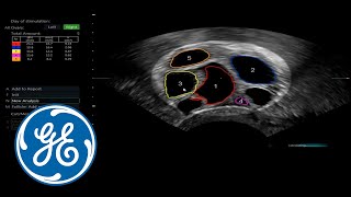 Voluson Performance 2016 clinical image | GE Healthcare