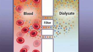Hemodialysis and how it works - IKAN ch6 - old vrs