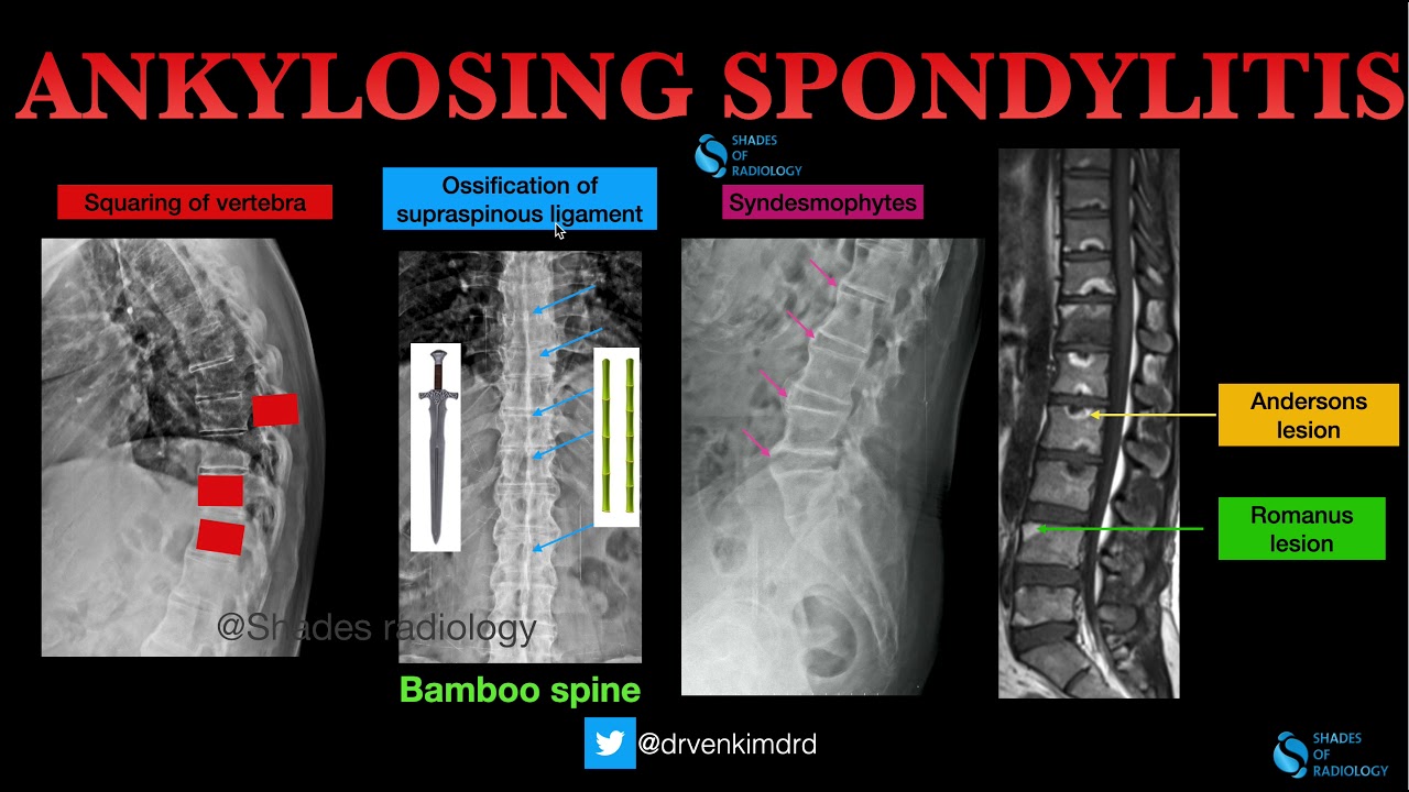 Ankylosing Spondylitis Classic Imaging Features Youtube