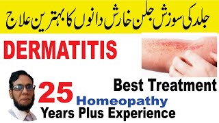 Dermatitis treatment-Homeopathy!-Skin Itching,khujli \u0026 jild ki Kharish ka ilaj urdu !!