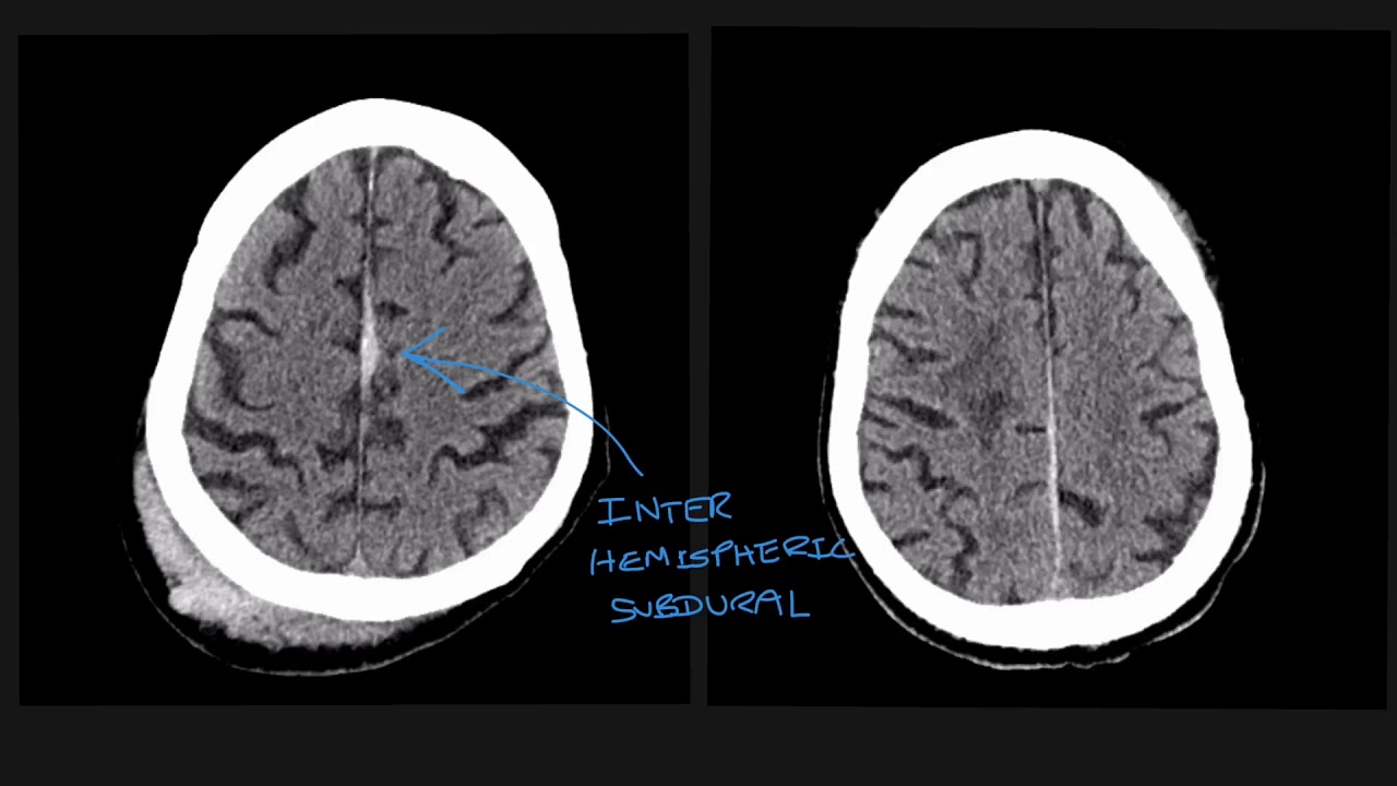 Understanding The Different Types Of Traumatic Brain Bleed On CT Scans ...