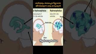 ശരിക്കും തലച്ചോറില്ലാതെ ജീവിക്കുന്ന ഒരു മനുഷ്യനോ 😱 !! World topics malayalam | #shorts