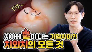 당신의 치아에 난 뿔, 의외로 흔하게 난다?! |치외치가 잘나는 사람과 시기, 치료법까지 다 알려드립니다