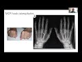 genetic haemochromatosis joint pain and arthropathy with professor patrick kiely