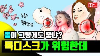 #뒷목 당기기 쉬운 #봄 두통까지 동반된다면 #목 #디스크 의심!