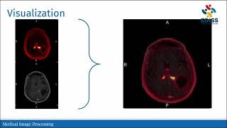 EDISS video series: Medical Image Processing at UIB