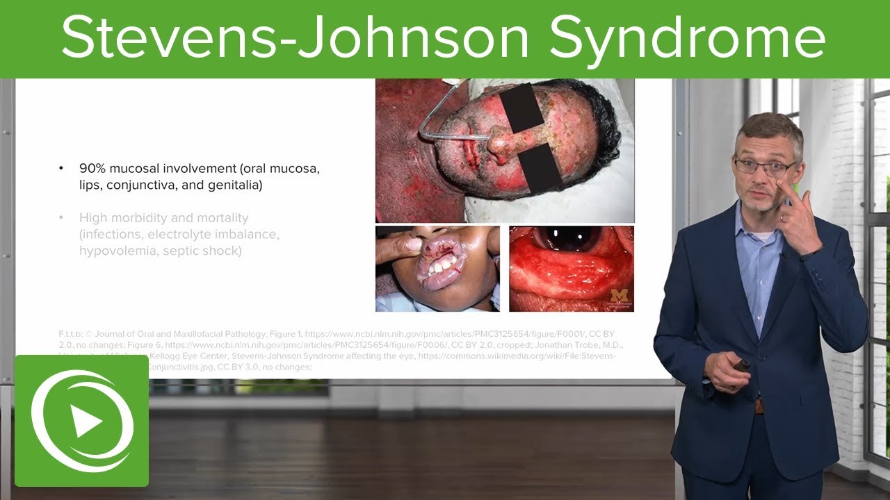 Stevens-Johnson Syndrome – Dermatology | Lecturio - YouTube