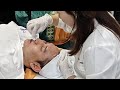 Microneedling RF radiofrequency skin rejuvenation treatment acne removal