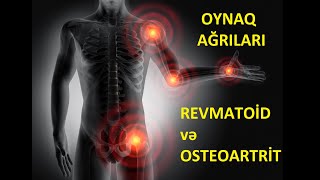 Oynaq ağrılarının səbəbi (Revmatoid və osteoartrit)