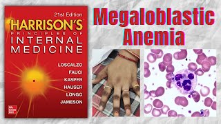 MEGALOBLASTIC ANEMIA | Causes | Clinical Features | Diagnosis | Treatment | Harrison