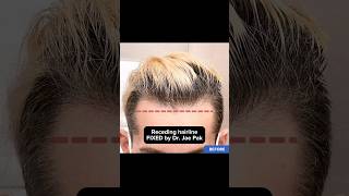 Receding hairline FIXED by Dr. Jae Pak #recedinghairline #hairline #hairtransplant