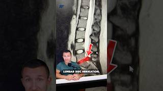 MASSIVE Disc Herniation in Low Back!