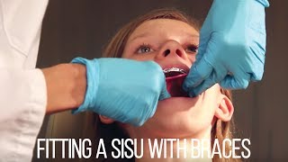 SISU Mouthguard | Fitting With Braces