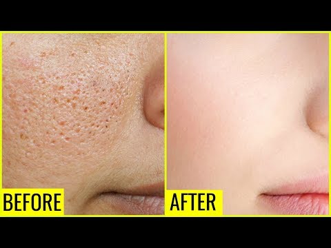 How to Get Rid of Large OPEN PORES Permanently | Anaysa How to Get Rid of Large OPEN PORES Permanently | Anaysa