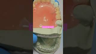 REMOVABLE DENTURE