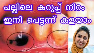 പല്ലിലെ കറുപ്പ് നിറം ഇനി പെട്ടന്ന് കളയാം|Root caries|Root exposure|black teeth