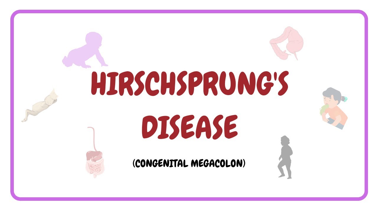 Hirschsprung's Disease | Congenital Megacolon | Symptoms ...