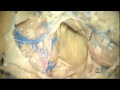 surgical approaches to the fourth ventricle tutorial by johnny delashaw m.d.