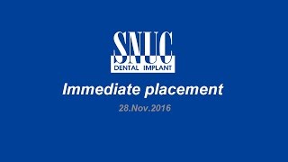 [ENG] 20161128 Immediate placement