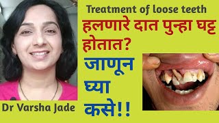 #हलणारेदात#looseteeth हलणारे दात कायमचे घट्ट होतात|कसलाही हलणारा दात घट्ट बसवा|हलणारे दातावर उपाय