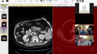 Renal manifestations of IGG4 - Dr Nelly Tan