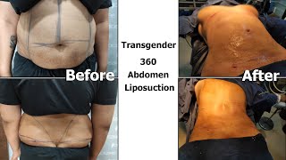 Transgender 360 Abdomen Liposuction result #shorts