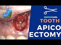 Apicoectomy surgery - Live procedure step by step