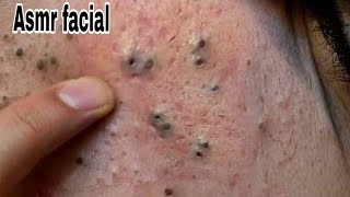 sac be spa blackheads elderly men face | sac be spa men face blackhead 2026 | sac be spa facial #390