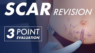 SCAR REVISION: Can a Surgical Scar be Corrected?