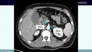 ACRO 2023: Clear as Mud: Approaches to Pancreas Cancer in the Neoadjuvant Setting