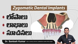 డెంటల్ ఇంప్లాంట్స్.! || Top Facts About Dental Implants || Zygomatic Implants Explained In Telugu