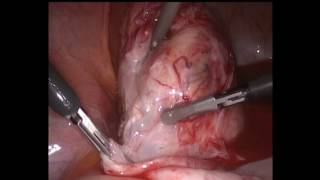 Hydrodissection technique in big dermoid cyt