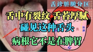 舌中有裂纹，舌苔厚腻，碰见这种舌头，病根它不是在脾胃