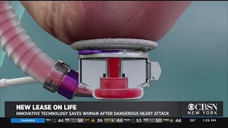 Innovative New Heart Pump Technology Giving Patients New Leases On Life