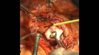 CME and central vascular ligation for locally invasive right-sided colon cancer by open approach