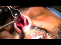 Rhinoplasty by Dr. Philip Miller