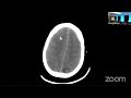 Aneurysmal Subarachnoid Hemorrhage