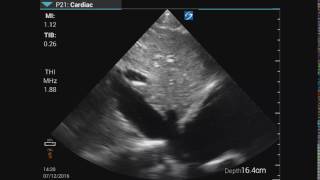 Long Axis Inferior Vena Cava