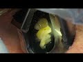 Time-lapse of first fully automated dental procedure