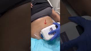 How to freeze your fat with CoolSculpting? | Dr. Swati Kannan #shorts