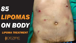 85 Lipomas Removal From Body ! Multiple Lipoma Treatment under Local Anesthesia